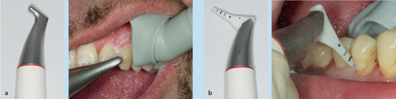 Abb. 5 a) Pulver-Wasserstrahl-Handstück mit konventioneller Düse (Airflow, EMS Electro Medical System S.A.; Nyon, Schweiz) für die supra- und subgingivale Reinigung unter Einsatz eines niedrig abrasiven Pulvers und bei klinischer Anwendung im Rahmen der Prophylaxe unter Verwendung einer großen Saugkanüle mit drehbarem Schild (Prophylaxekanüle, Dürr Dental SE, Bietigheim-Bissingen, Deutschland). b) Pulver-Wasserstrahl-Handstück mit Nozzle-Aufsatz (Perioflow, EMS Electro Medical System S.A.; Nyon, Schweiz) bei subgingivaler Anwendung an Zahn 44 mit lokalisiert erhöhten ST von bis zu 7 mm im Rahmen der unterstützenden Parodontitistherapie.