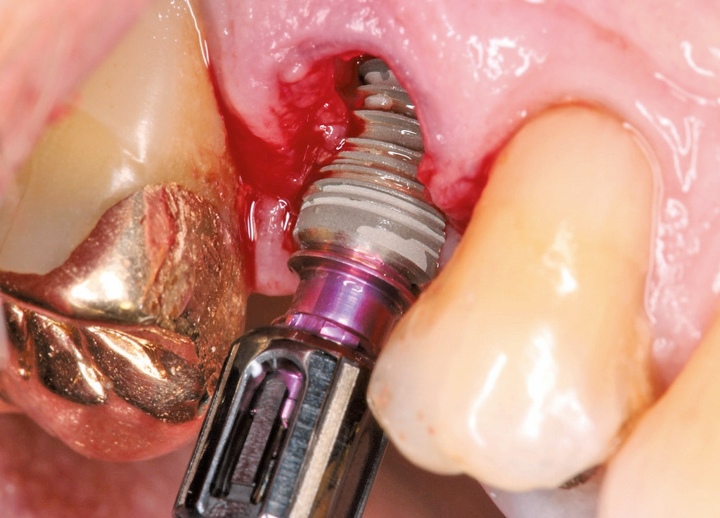Abb. 5: Insertion des Implantats mit Einbringinstrument.