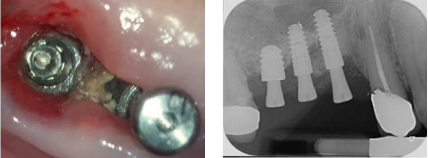 Abb. 6 u. 7: Ausgeprägte Periimplantitis, hier mit deutlicher Sequesterbildung an den Implantaten 14 und 15.