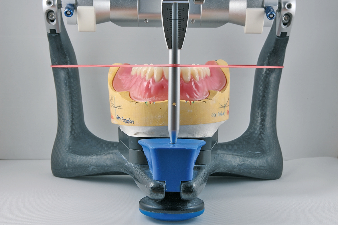 Abb. 5: Unterkieferfront mit Gummiband zur Orientierung.