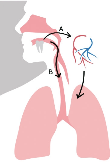 Abb. 5: Wege der pathogenen Keime und Entzündungsmediatoren von der Mundhöhle in die Lunge über den Blutkreislauf (A) und/oder direkt durch Aspiration
(B).