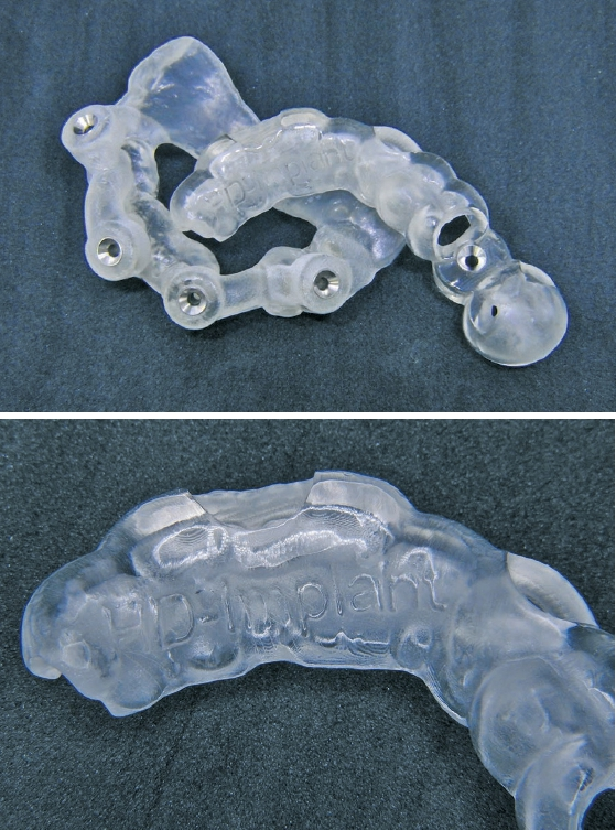 Abb. 5a u. b: Bohrschablonen mit FREEPRINT® ortho 385.