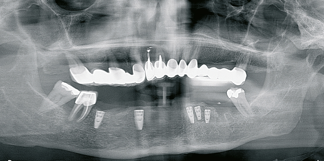 Abb. 4: Implantate im Unterkiefer in situ.