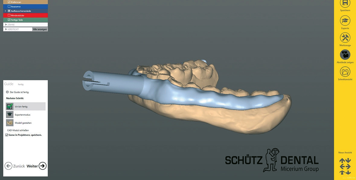 Abb. 5: Paraokklusaler Löffel als Träger für das zebris-System, in der Schienensoftware modelliert.