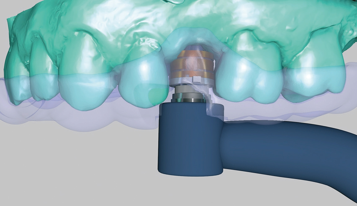 Abb. 3: Bei dieser Situation ist die kieferkammnahe Hülsenposition für einen 20-mm-Bohrer gerade noch möglich.