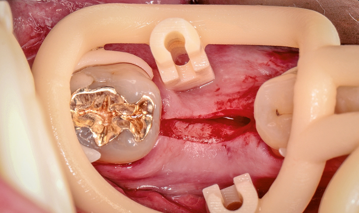 Abb. 5: Das reduzierte Design der Bohrschablone bietet intraoperative Übersicht.