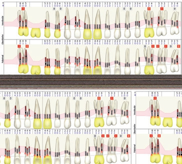 Abb. 3: Parodontalstatus (PA-KONZEPTE, Sendenhorst): generalisiertes Bluten auf Sondieren und erhöhte Taschensonderungstiefen von bis zu 8 mm. Die Furkationsbeteiligung der Zähne 17, 26, 27, 38, 46 und 47 betrug Grad I bis II. Es lagen Beweglichkeiten von Grad I bis II an den Zähnen 11, 44, 45, 46 und 47 vor.