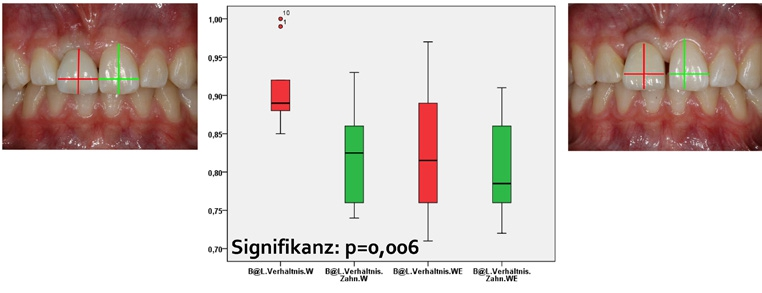 Abb. 20a: Boxplots zur Darstellung des Breiten-Längen-Verhältnisses von Implantatkronen (rot) und korrespondierenden Zähnen (grün) zum Zeitpunkt der Eingliederung im Wachstum (W) (links) und bei der Kontrolluntersuchung nach Abschluss des Kieferwachstums.