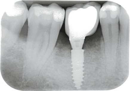 Abb. 7: Auch die röntgenologischen Ergebnisse sind überzeugend: Zustand ein Jahr postoperativ nach Implantation und Prothetik regio 45 (Champions (R)Evolution ø 3,5 mm, Länge 10 mm), die wiederum nur zwei Monate post extractionem/ Smart Grinder-Anwendung erfolgte.