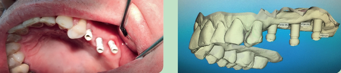 Abb. 5 und 6: Implantatabformung mit dem iTero Element.