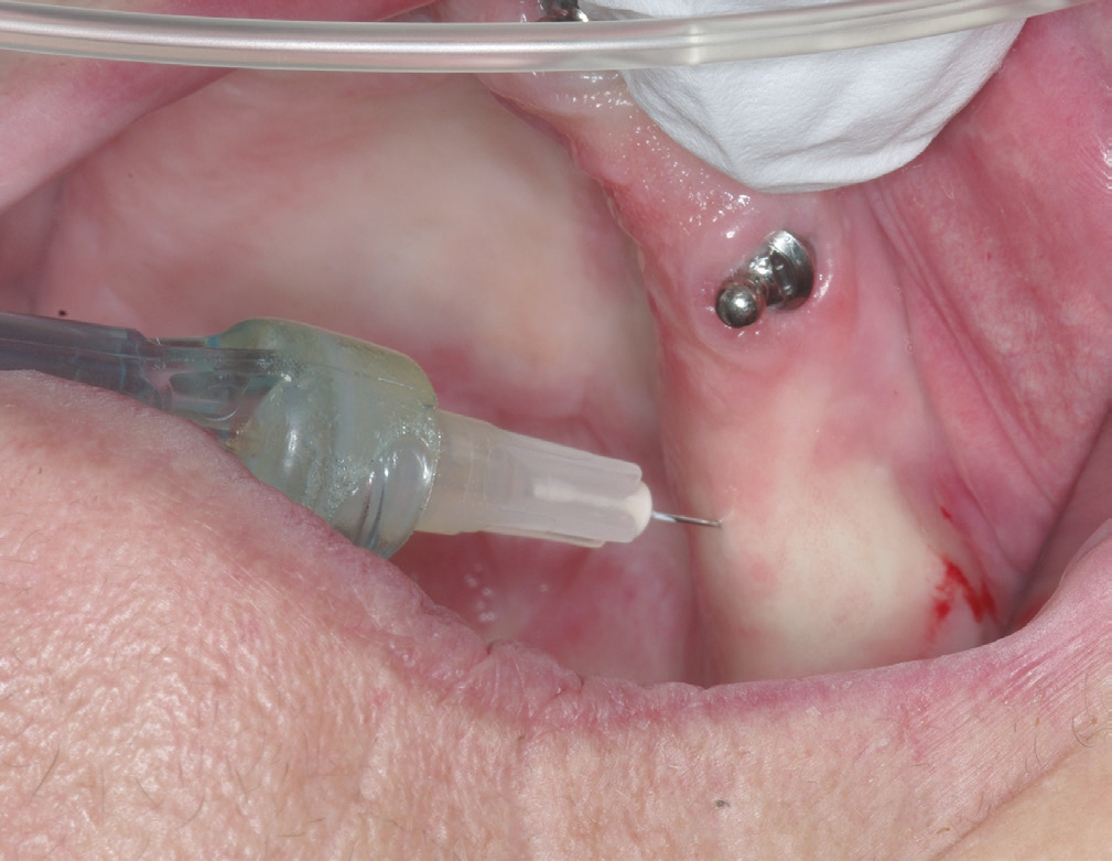 Abb. 5: Die Implantation erfolgt unter minimalinvasiver intraligamentärer Anästhesie – das Touchieren eines Nervs wird sicher vom Patienten gespürt, sodass bei Bedarf sofort reagiert werden kann.