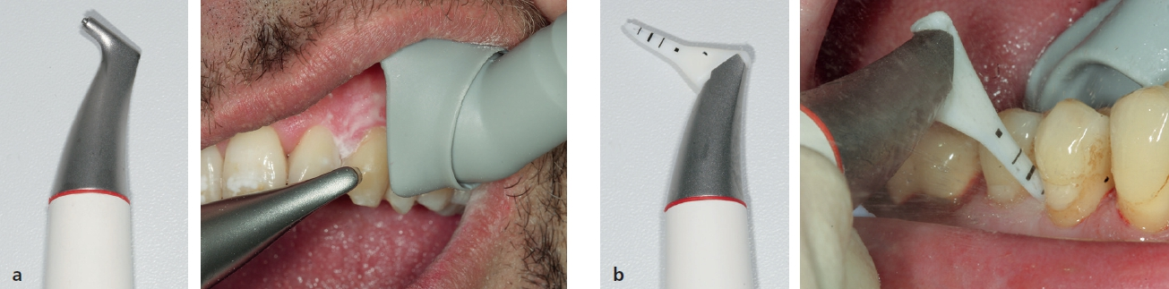 Abb. 5 a) Pulver-Wasserstrahl-Handstück mit konventioneller Düse (Airflow, EMS Electro Medical System S.A.; Nyon, Schweiz) für die supra- und subgingivale Reinigung unter Einsatz eines niedrig abrasiven Pulvers und bei klinischer Anwendung im Rahmen der Prophylaxe unter Verwendung einer großen Saugkanüle mit drehbarem Schild (Prophylaxekanüle, Dürr Dental SE, Bietigheim-Bissingen, Deutschland). b) Pulver-Wasserstrahl-Handstück mit Nozzle-Aufsatz (Perioflow, EMS Electro Medical System S.A.; Nyon, Schweiz) bei subgingivaler Anwendung an Zahn 44 mit lokalisiert erhöhten ST von bis zu 7 mm im Rahmen der unterstützenden Parodontitistherapie.