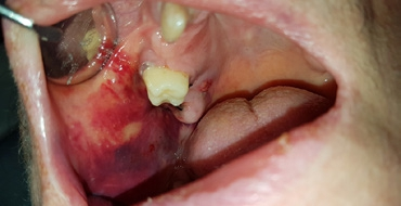 Abb. 4: Postoperatives Wangenhämatom nach operativer Entfernung des Zahnes 17, mit palatinalem Fistelgang, positiver MAV, plastischer Deckung und einem INR von 2,9.
