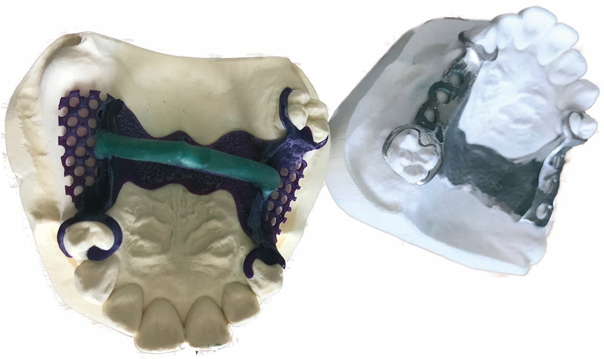 Abb. 5: Die Modellguss-Modellation wird erst in ausbrennbarem Material hergestellt, dann eingebettet und schließlich konventionell gegossen.