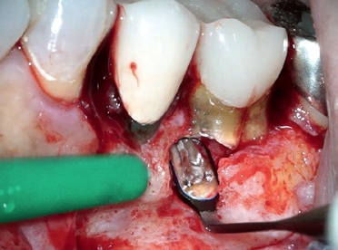 Abb. 5: Besonders in diffizilen Diagnostik- oder Behandlungssituationen leisten die Mikrospiegel hilfreiche Dienste. Zu beachten ist der manuell abgewinkelte Spiegelschaft; dies ist nur mit diesen speziellen Instrumenten aus der MICROflex-Produktreihe möglich.