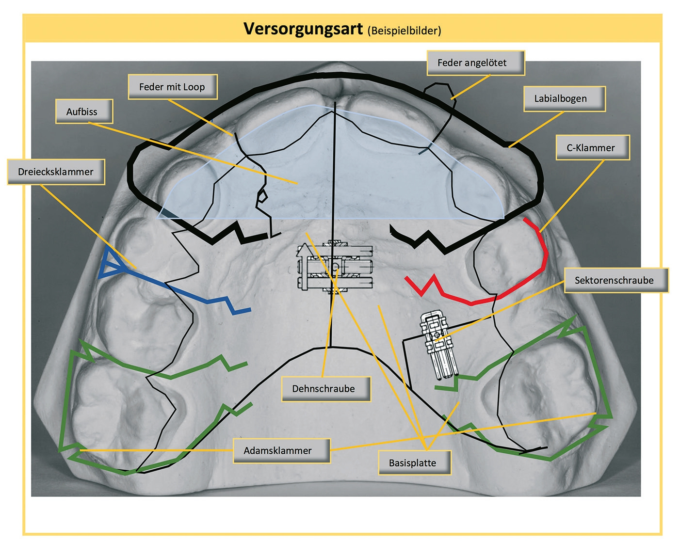 Abb. 5: Beispiel einer Versorgung mit der Dehnplatte nach Schwarz.