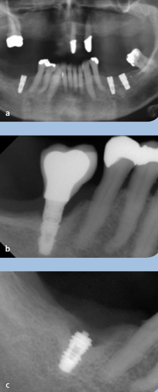 Abb. 6 a-c: Röntgenpanoramaschichtaufnahme nach Insertion von drei Implantaten – vorgesehene Einzelkrone 46 (a). Röntgenbild nach Kronenversorgung (b). Implantatfraktur nach fünf Jahren infolge Überlastung (c).