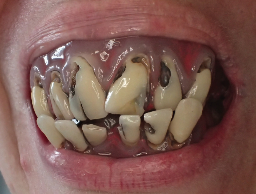 Warum soll es Ungeheuern besser gehen als den Menschen ...? Karies hier wie dort.