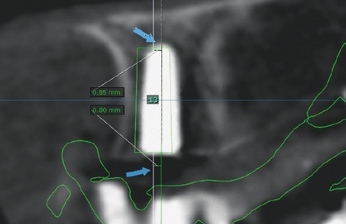 Abb. 6: Vergleich präoperative Planung und postoperative Situation im DVT: Grüne Planungsposition überlagert Kontroll-DVT. Die Abweichung zur geplanten Position: 0,8 mm.