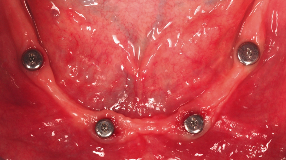 Abb. 7: Einheilpfosten (PS HP) in situ zwei Monate nach Implantatinsertion.