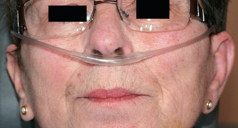 Abb. 5: Zusätzliche Zufuhr von Sauerstoff über eine Nasenbrille bei einer Patientin mit Lungenfibrose.