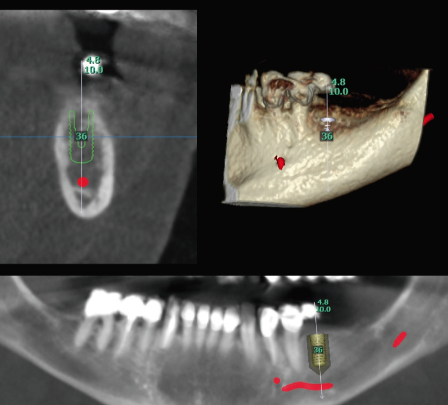 Abb. 4: Ausschnitte einer Aufnahme im Low-Dose-Modus zur präoperativen Beurteilung des Implantatlagers regio 36 (KaVo OP300 Maxio FOV Ø 8 x 8 cm).