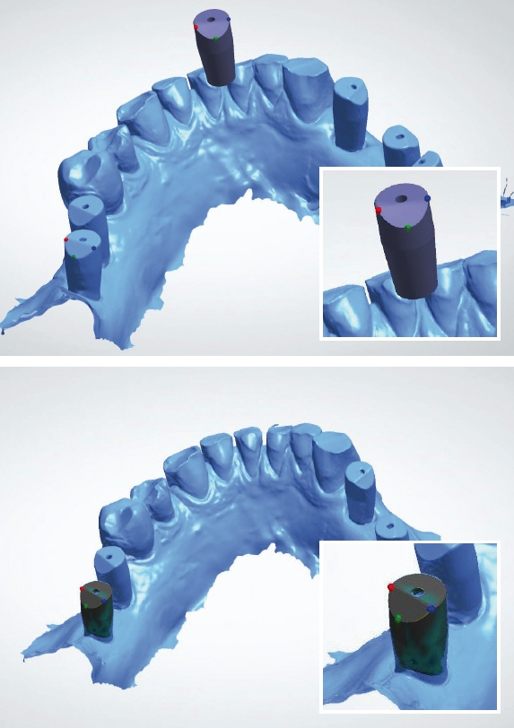 Abb. 6a u. b: Matching der Implantatbibliothek mit dem Scanbody über drei Punkte.