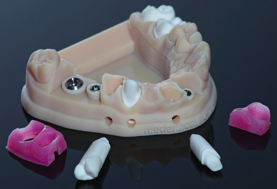 Abb. 7: Implantat-Modell mit steckbaren Elementen und Multimaterialien – hergestellt auf einem 3D-Drucker ohne Materialwechsel (3D Medical Print, A-Lenzingen).