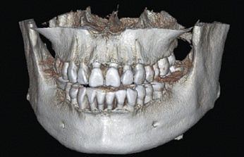 Abb. 5: Mithilfe von DVT-Daten ist eine dreidimensionale Darstellung und Vermessung des parodontalen Knochendefizites im zahntragenden Alveolarfortsatz möglich.