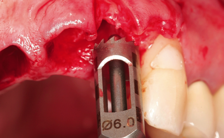 Abb. 5: Instrumentatium des maxgraft® bonering kits passend für 6 mm oder 7 mm maxgraft® bonering.