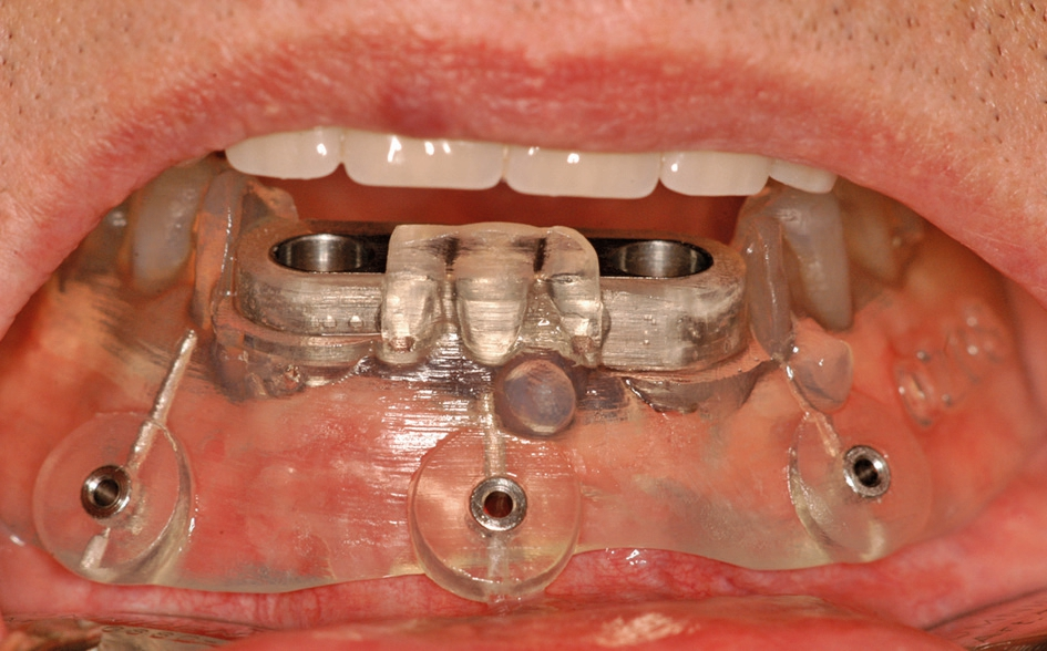 Abb. 6: Die SOS-Schablone wird durch die Gegenbezahnung (hier OK-Totalprothese) in zugebissenem Zustand auf dem Unterkiefer stabilisiert, bevor sie mit den Pins befestigt wird.