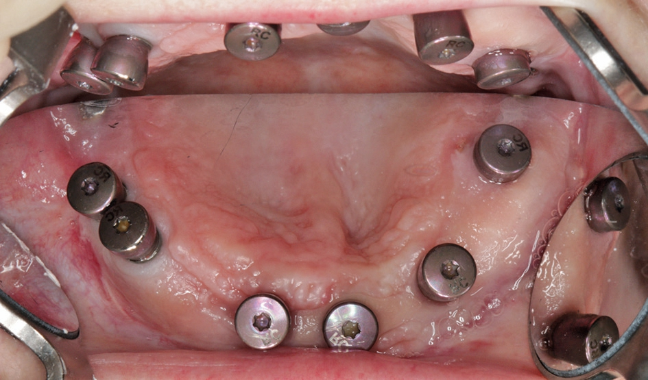 Abb. 6: Klinische Ausgangssituation nach Implantation und Freilegung im Oberkiefer in der Aufsicht; aufgrund der geringen Mundöffnung und der zierlichen Anatomie des Oberkiefers ist die Abbildung der posterioren Implantate mit Spiegel in diesem Fall nicht möglich.