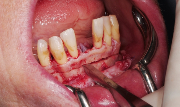 Abb. 6: Abtrennen des Alveolarkamms.