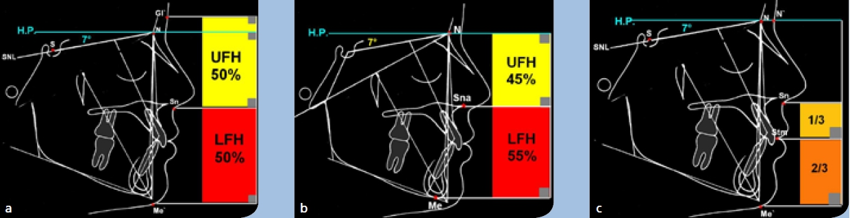 Abb. 6a–c: Die vertikale Einteilung des Gesichtes zwischen G’ und Me’ im FRS in Bezug auf die Horizontalebene (HP). a) Die harmonische Relation von oberer G’-Sn (upper facial height: UFH) zu unterer Gesichtshälfte Sn-Me’ (lower facial height: LFH) beträgt 1:1. b) Skelettale Einteilung des Gesichtes in der Vertikalen, die Relation zwischen dem Mittel- und Untergesicht in Bezug auf die Spina nasalis anterior (N-Sna:Sna-Me) beträgt 45 % zu 55 %. c) Vertikale Einteilung des Untergesichtes (Sn-Me’). Das Verhältnis der Oberlippe (Sn-Stm bzw. Stms) zur Unterlippe und dem Kinn (Stm bzw. Stm-Me’) beträgt in Ruheschwebelage 1:2.