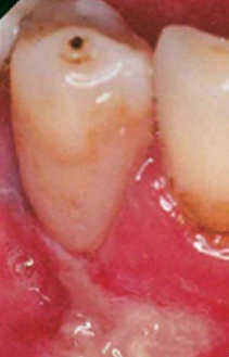 Abb. 4: Verätzung der Gingiva durch ein SE-Adhäsiv [51] Aus: G. Schmalz, D Arenholt-Bindslev: Biocompatibility of Dental Materials, Springer, Heidelberg, 2009.