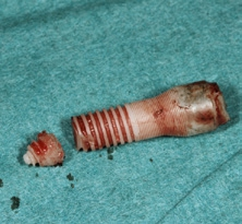 Abb. 6: Die Fragmente wurden zur Kontrolle der Vollständigkeit des explantierten Implantats aneinandergelegt.