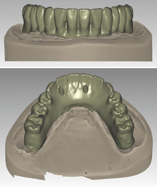 Abb. 9 u. 10: Generierte STL/implantatgetragene Anatomie.