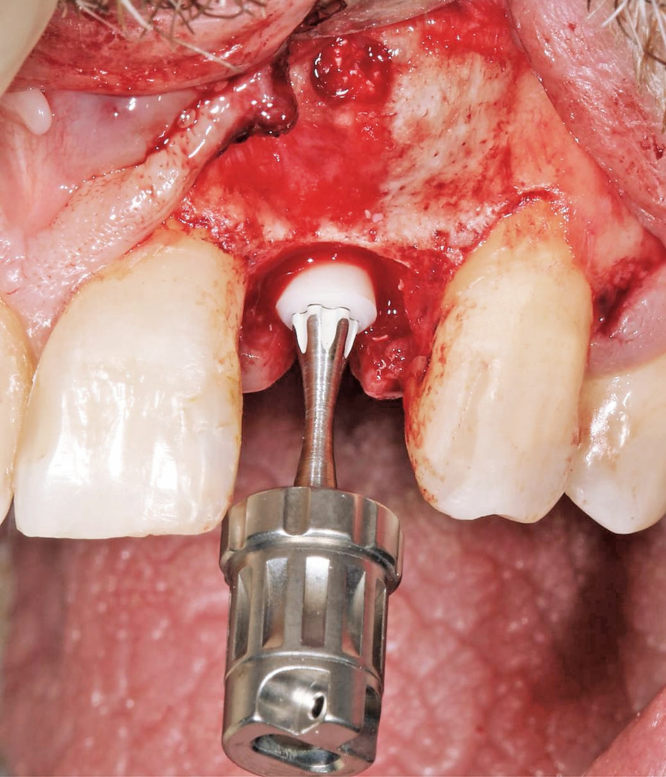Abb. 6: Um das neue Implantat (CERALOG Hexalobe) gewebeschonend einzubringen, wurde es manuell inseriert und die Implantatschulter 1 mm suprakrestal platziert.