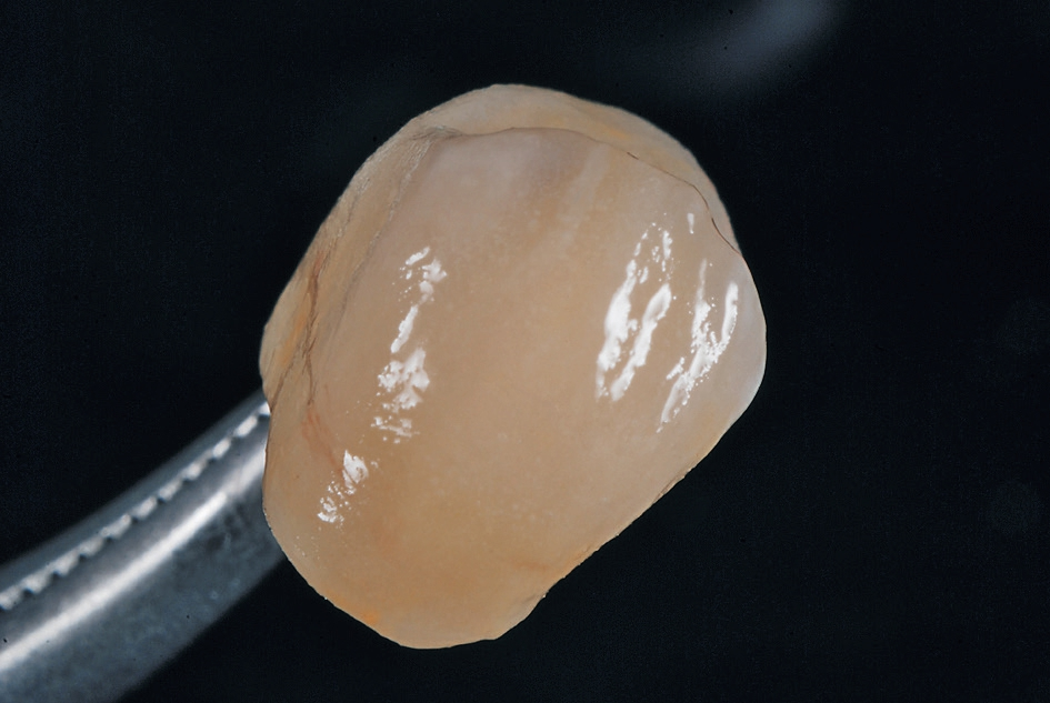 [6] Beim Finish entscheide ich mich für die individuelle Charakterisierung mit Malfarben aus dem HeraCeram Stains universal Kit. Die einfach geschichtete Krone hat bereits eine harmonische Ausstrahlung. Deshalb muss ich nur wenige Akzente mit den Intensivfarben setzen.
