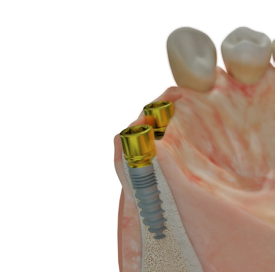 Abb. 7: Unter direkter Knochensicht werden die Implantate mit 30 Ncm Primärstabilität inseriert. Bukkal liegt die befestigte Gingiva nun ca. 1 mm höher als lingual.