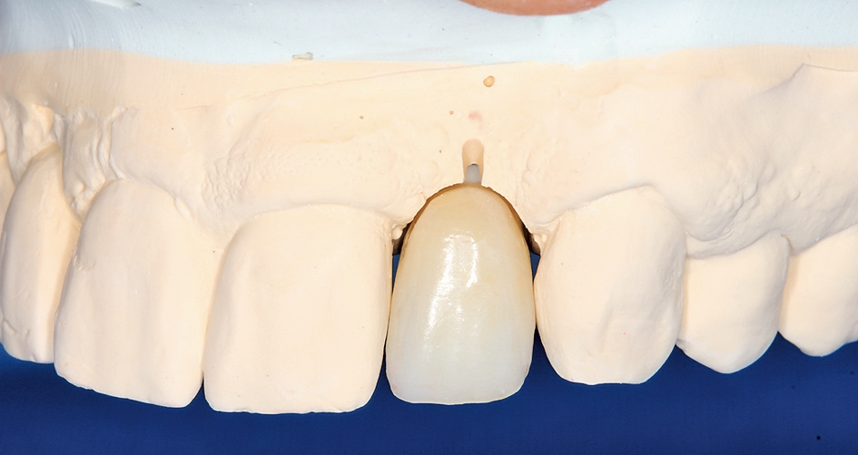 Abb. 21: Um die Interdentalpapillen zu erhalten, wurden die Kontaktpunkte den Tarnow-Regeln folgend 4 mm oberhalb des Knochens angelegt.