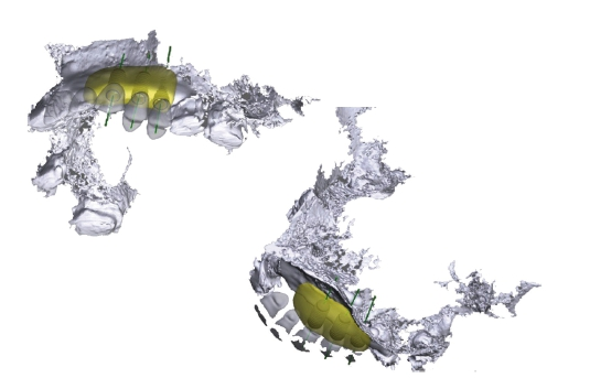 Abb. 43: 3D-Planung des Bone Builders.