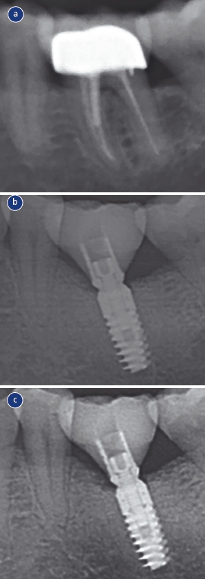 Abb. 5: Radiologische Darstellung von Patient 15. a) Röntgenaufnahme von Zahn 36 vor Extraktion aufgrund persistierenden Schmerzen. b) Röntgenaufnahme des inserierten Sofortimplantats regio 36 unmittelbar nach prothetischer Versorgung. c) Röntgenaufnahme des Implantats regio 36 zum Zeitpunkt der Zwei-Jahres-Nachuntersuchung. Das marginale Knochenniveau zeigt sich stabil und erreicht die Implantatschulter.