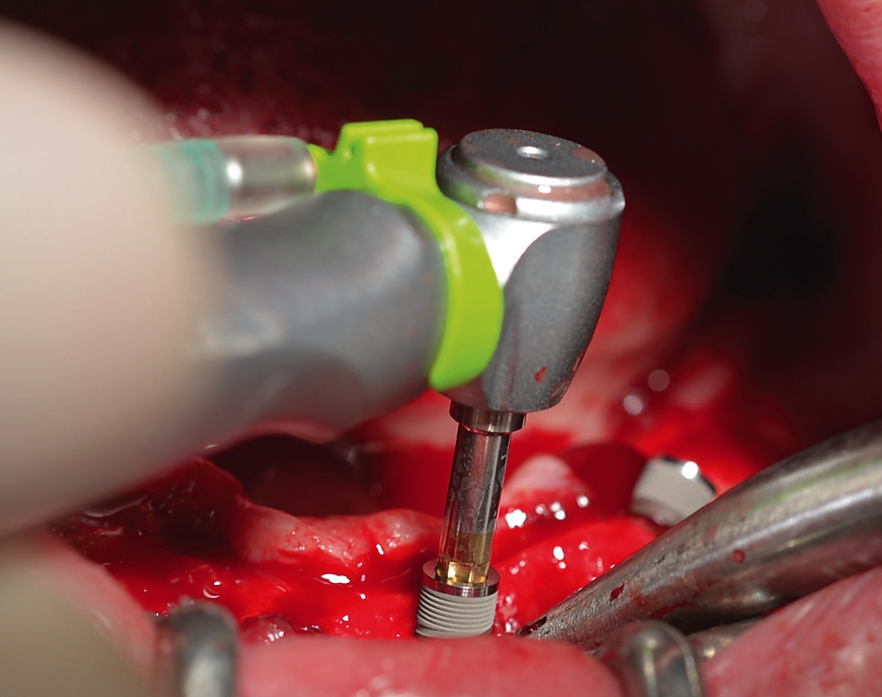 Abb. 8: Interforaminales Einbringen eines narrowSKY-Implantates in regio. 32.