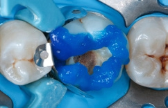 Abb. 6: Selektive Schmelzätzung mit 35%igem Phosphorsäuregel.