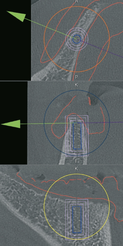 Abb. 6: Exemplarische Implantatplanung an regio 45. Hier sieht man nicht nur den Knochen und das gewählte Implantat (Durchmesser 3,5 mm, Länge 11 mm), sondern auch Prothese und Zähne.