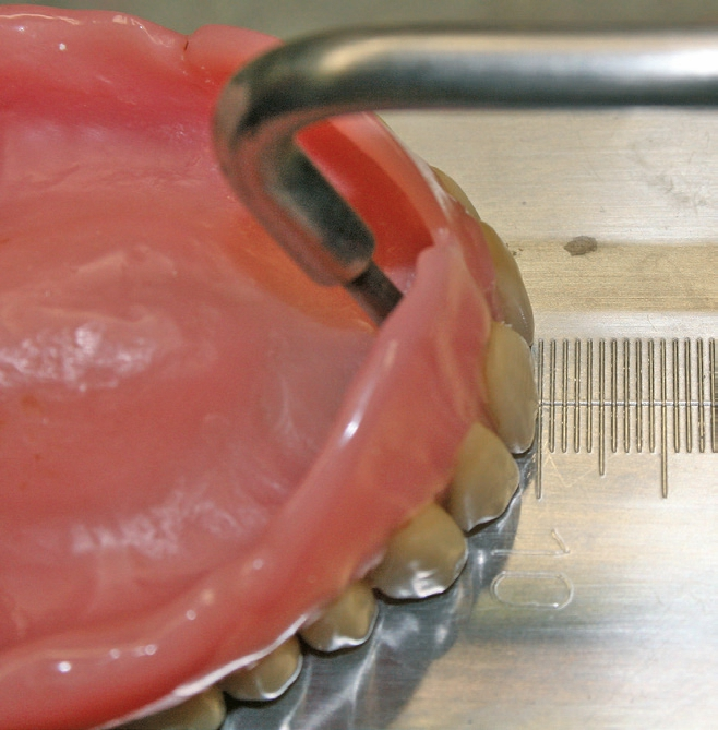 Abb. 2e: Vermessung der 1er-Position nach labial.