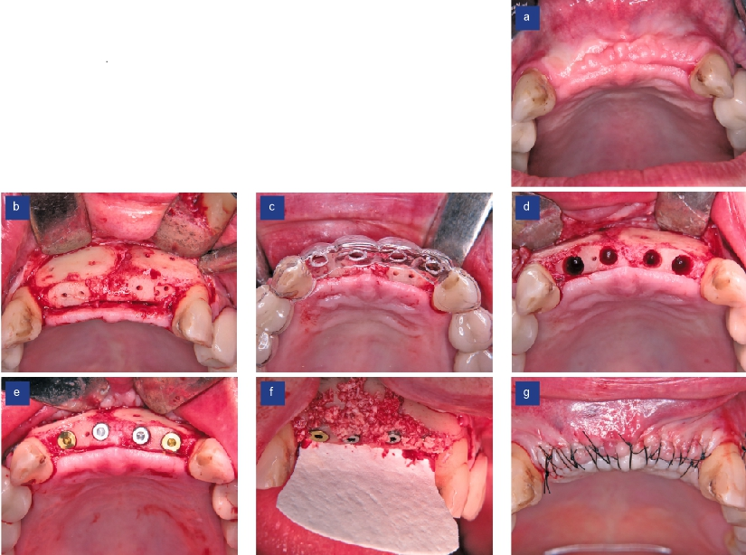 Abb. 6: Situation bei Re-entry (a), Freilegung der Augmentationsstelle (b), Planung der Implantatposition (c), Pilotbohrungen (d), Insertion der Implantate (e), Abdecken der Operationsstelle mittels Barrieremembran (f), speicheldichter Wundverschluss (g).