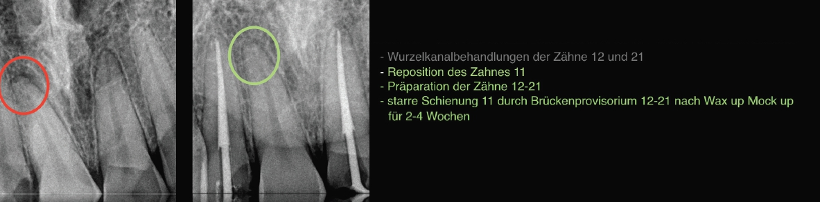 Abb. 8: WK-Behandlung der Zähne 12 und 21.
