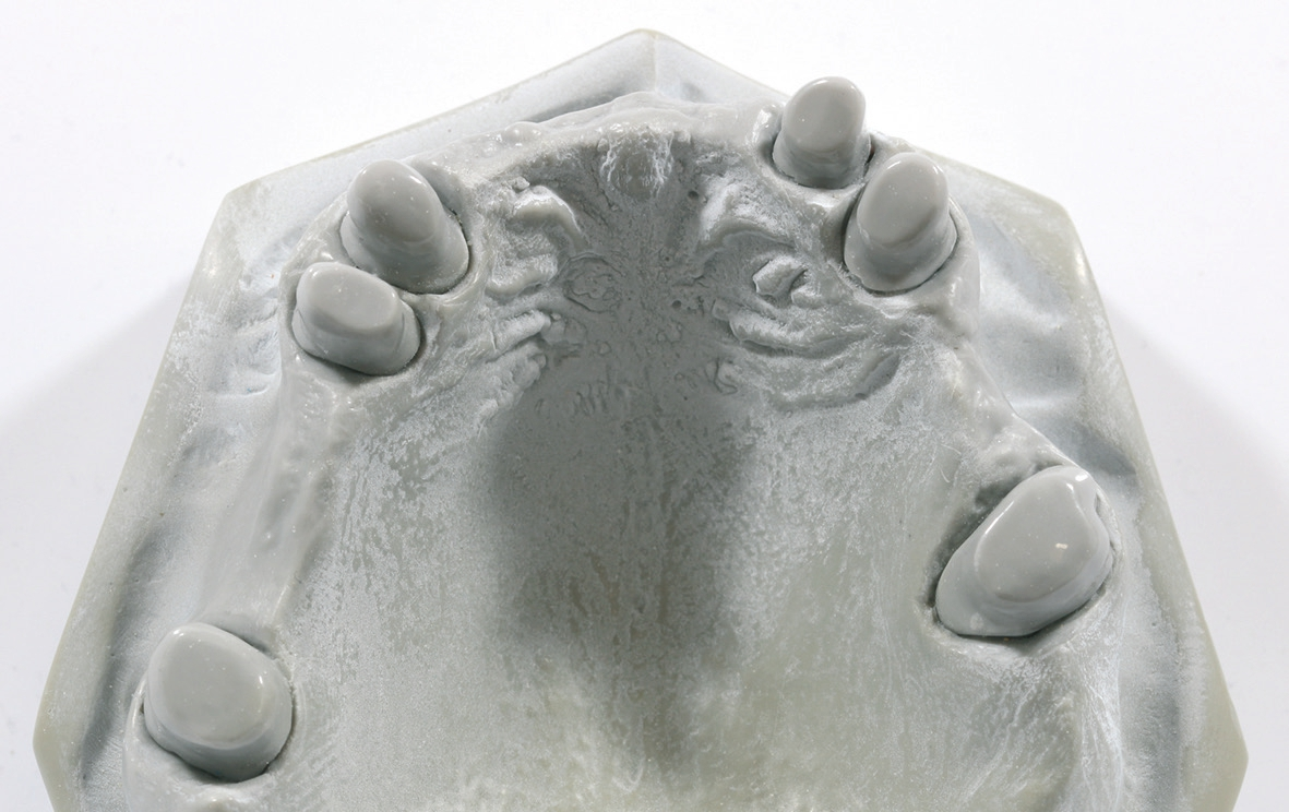 Abb. 4: Primärteile aus Zirkoniumdioxid in situ. Der Patient benötigt eine Revision seiner Prothese.
